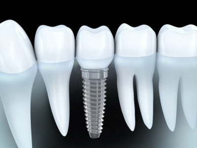 Implant dentaire Implant dentaire