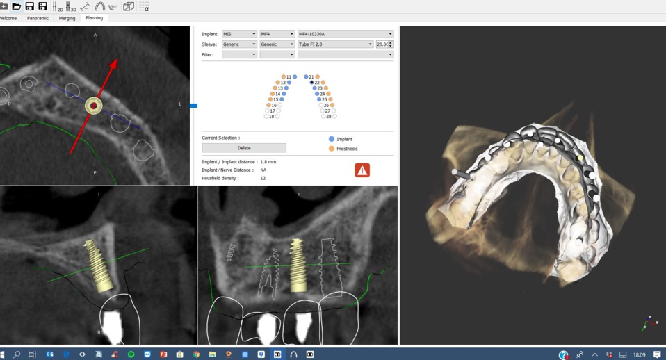 Implant assisté par ordinateur Dr Rattier Implant assisté par ordinateur Dr Rattier
