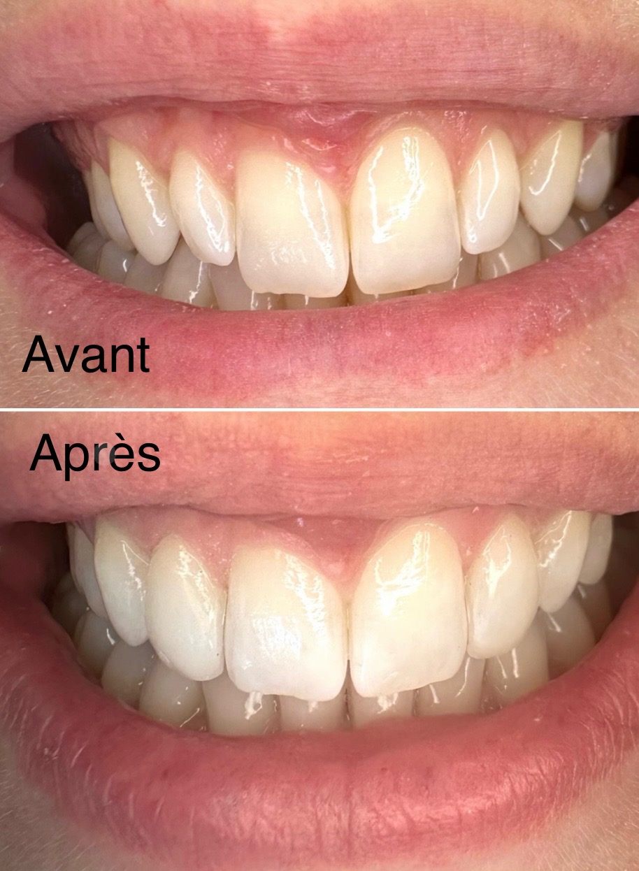 Sourire, l'esthétique à moindre coût avec une technique de soins dentaires conservatrice Sourire, l'esthétique à moindre coût avec une technique de soins dentaires conservatrice