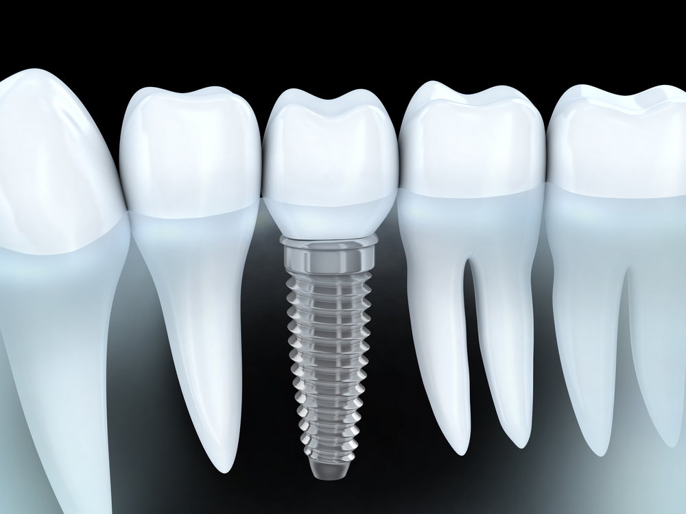 Couronne dentaire, pivot, couronne sur implant, qu'est-ce que c'est?