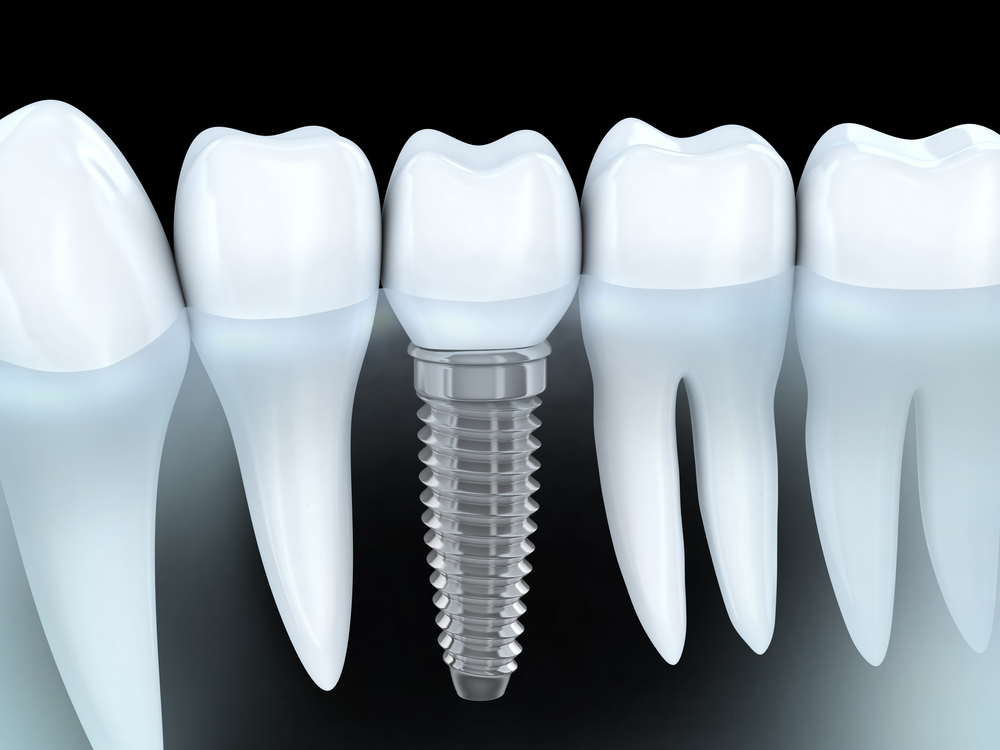 Implant dentaire Implant dentaire