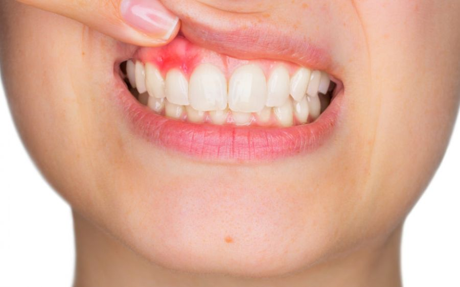 Parodontie et soins de la gencives Parodontie et soins de la gencives